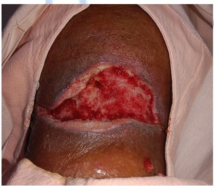 Before Treatment